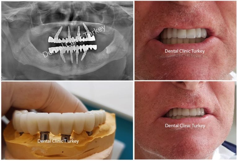 Implant Treatment with All On 4 Technique Dental Clinic Turkey