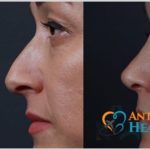 rhinoplasty turkey plastic surgery nose job