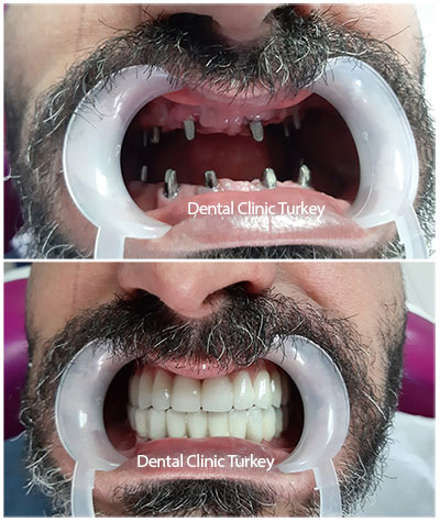 full mouth dental implants man