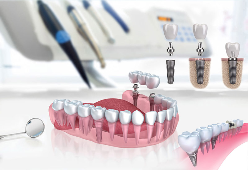 Implants Dentaires En Turquie Antalya Devis Consultation