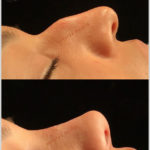 rhinoplasty before and after 5