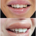 zirconium crown for hollywood smile