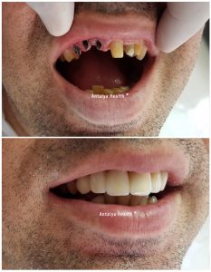 seule dent