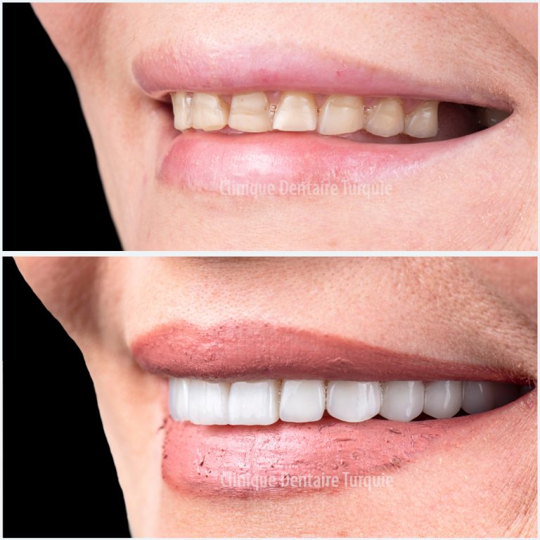Porcelain Veneers Cheap Veneers Dental Clinic Turkey