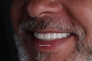 All on Six Dental Implant