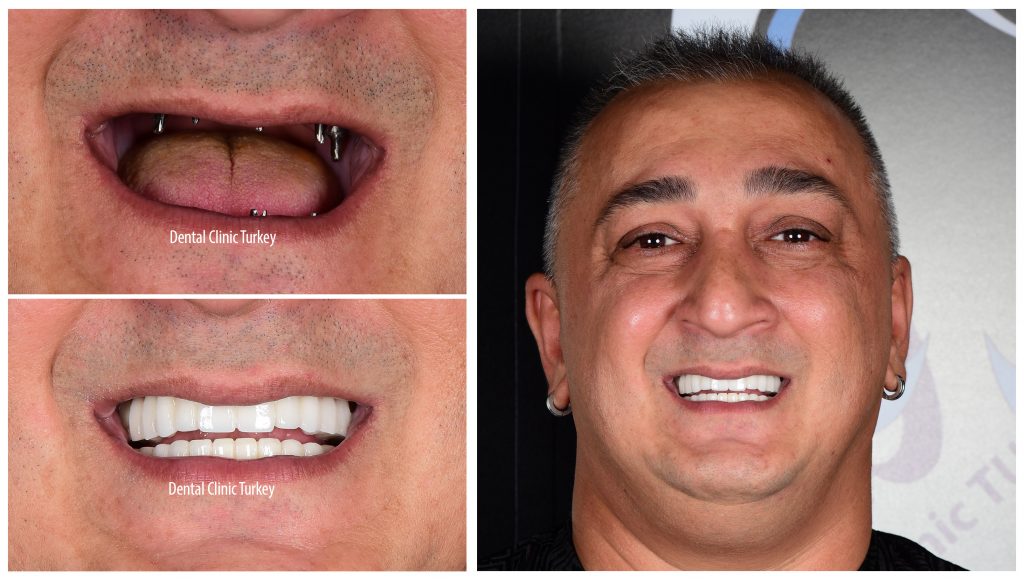 full mouth implant treatment