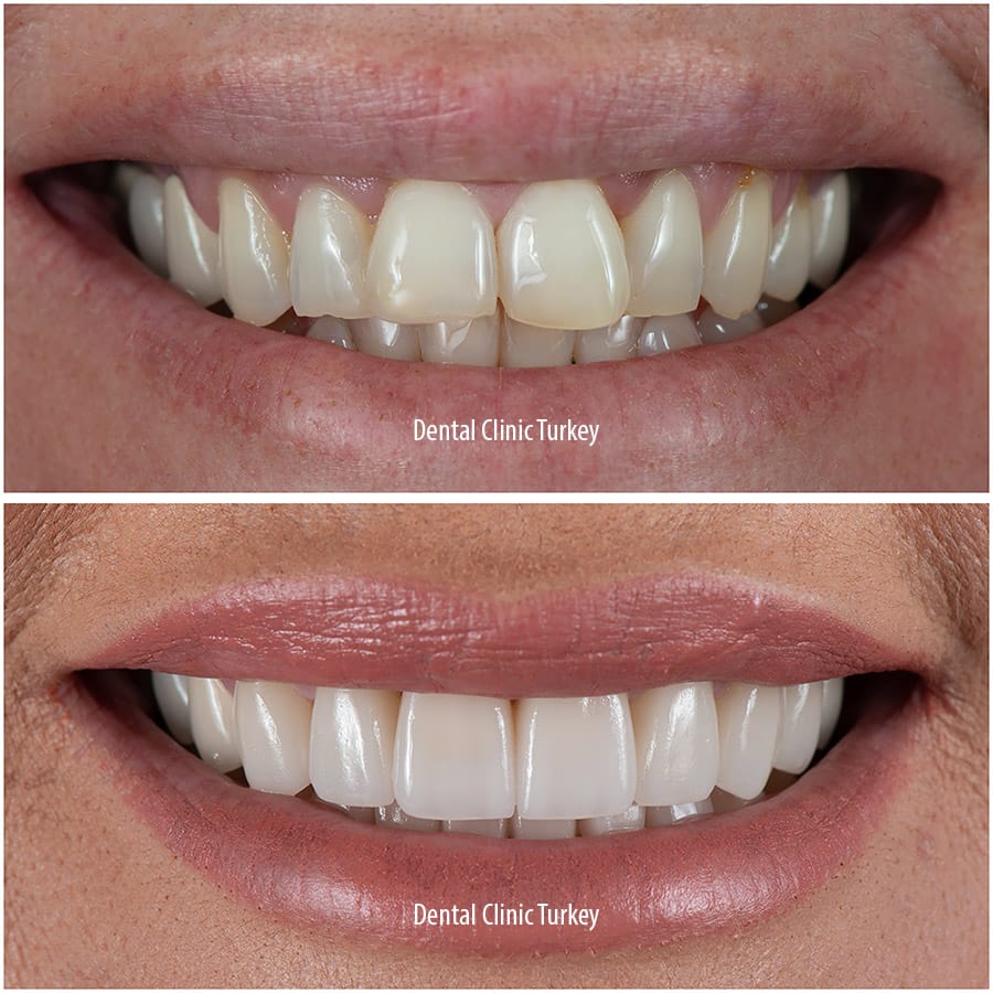 Zirconium Teeth In Turkey Dental Clinic Turkey Antalya Zirconium Teeth In Turkey Dental Clinic Turkey Antalya
