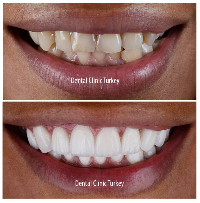 Zirconium Teeth In Turkey Dental Clinic Turkey Antalya Zirconium Teeth In Turkey Dental Clinic Turkey Antalya